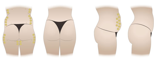 Buttock-Lipofilling-Tunisia